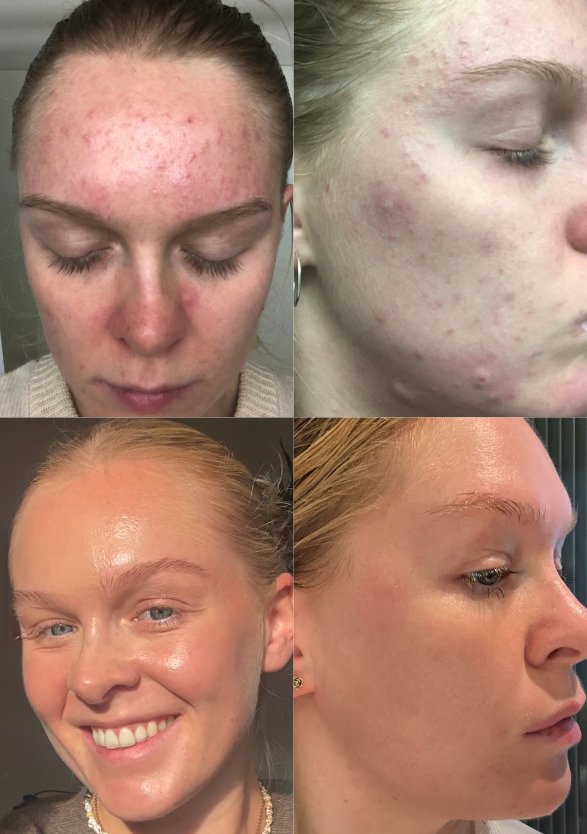 Before and after - Ida's skin across 16 years with acne